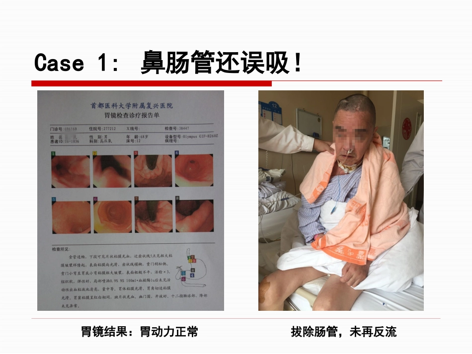 神经重症患者康复期肠内营养途径选择_第13页