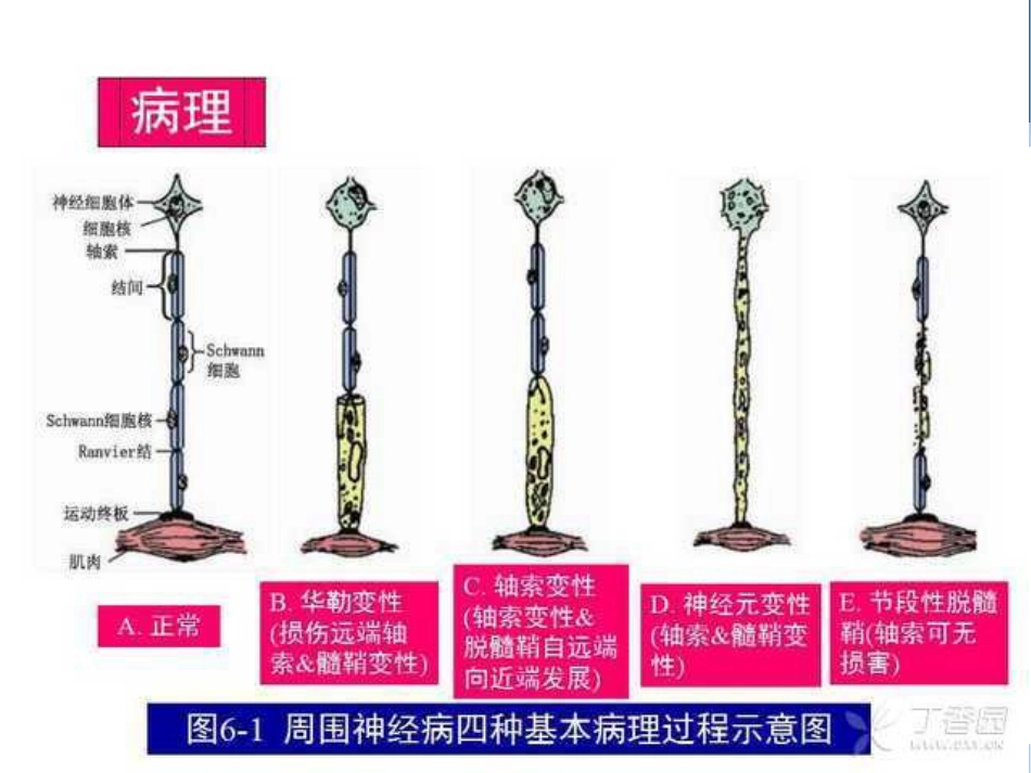 吉兰-巴雷综合征分型与诊断_第4页