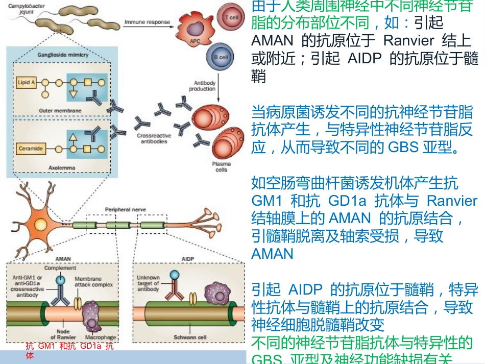吉兰-巴雷综合征分型与诊断_第7页