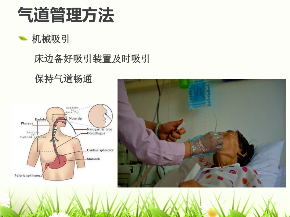 危重患者的气道管_第10页