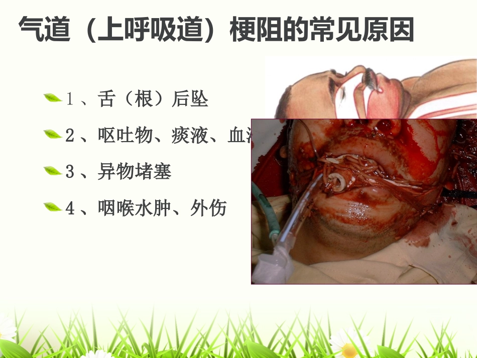 危重患者的气道管_第7页