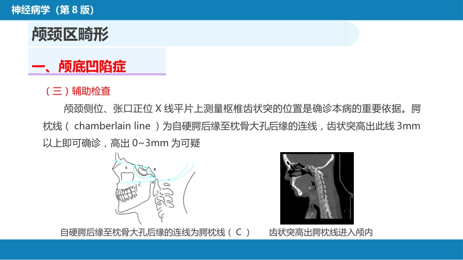 第二十一章 神经系统发育异常性疾病_第8页