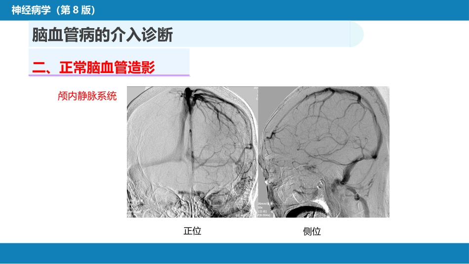 第十章 脑血管病的介入诊疗（1）_第10页