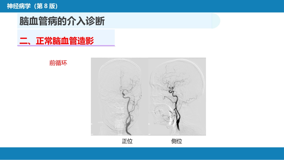 第十章 脑血管病的介入诊疗（1）_第8页