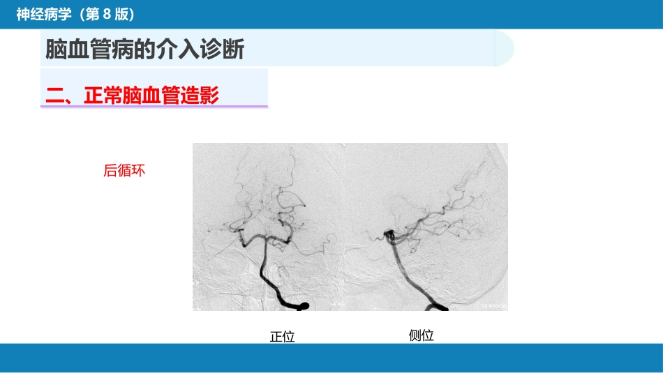 第十章 脑血管病的介入诊疗（1）_第9页
