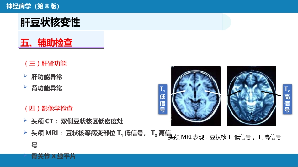 第十四章 运动障碍性疾病（2）_第9页