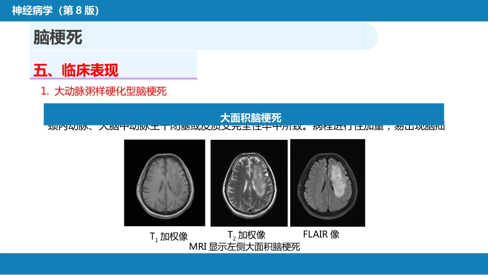 第九章 脑血管疾病（2）_第15页