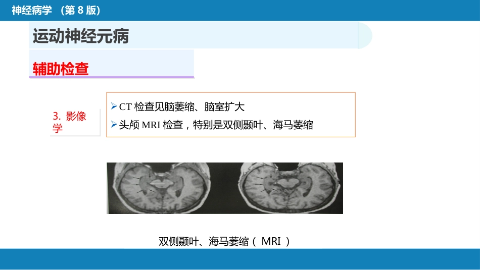 第十一章 神经系统变性疾病（2）_第13页