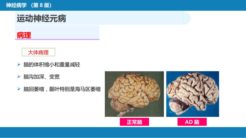 第十一章 神经系统变性疾病（2）_第8页
