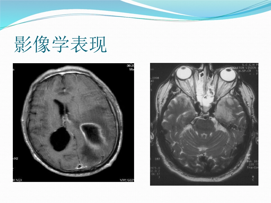 中枢神经系统感染 (2)_第10页