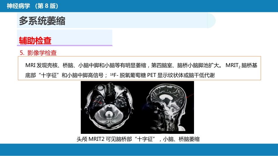第十一章 神经系统变性疾病（3）_第14页