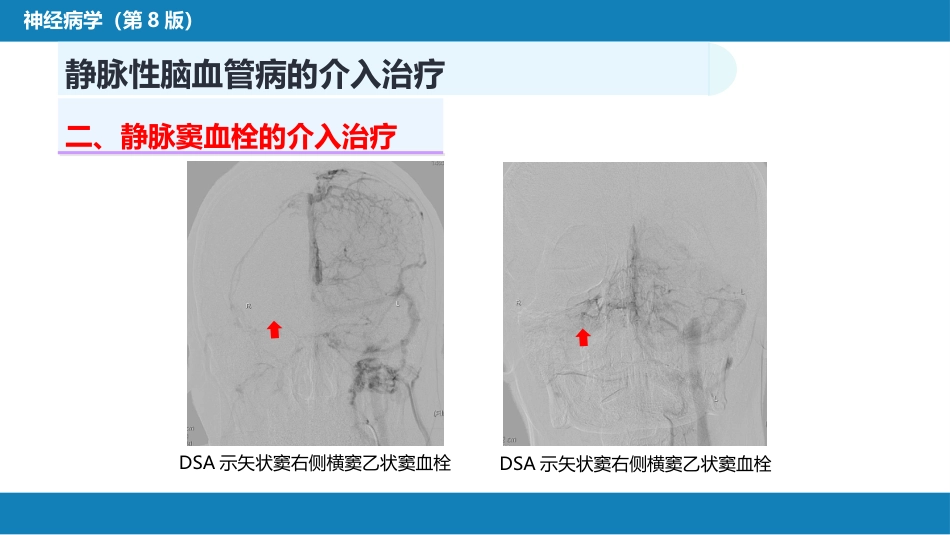 第十章 脑血管病的介入诊疗（3）_第10页