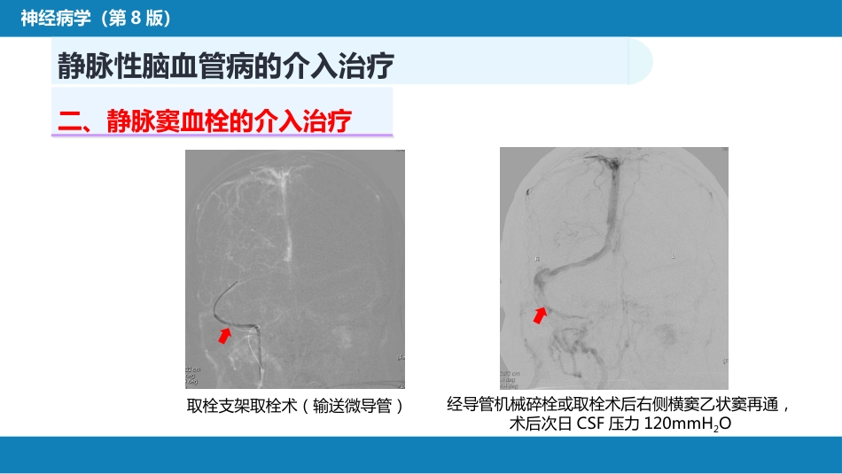 第十章 脑血管病的介入诊疗（3）_第11页