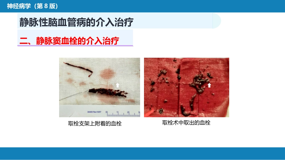 第十章 脑血管病的介入诊疗（3）_第12页