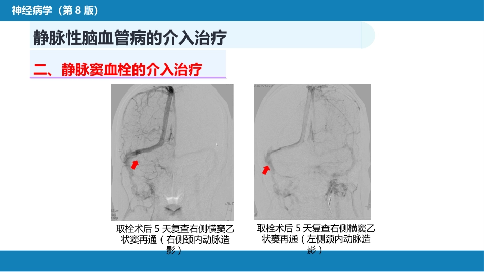 第十章 脑血管病的介入诊疗（3）_第13页