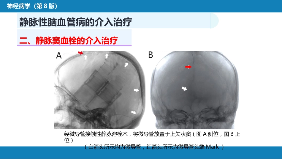第十章 脑血管病的介入诊疗（3）_第6页