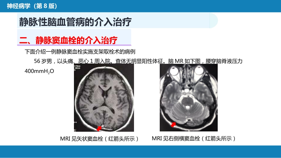 第十章 脑血管病的介入诊疗（3）_第9页