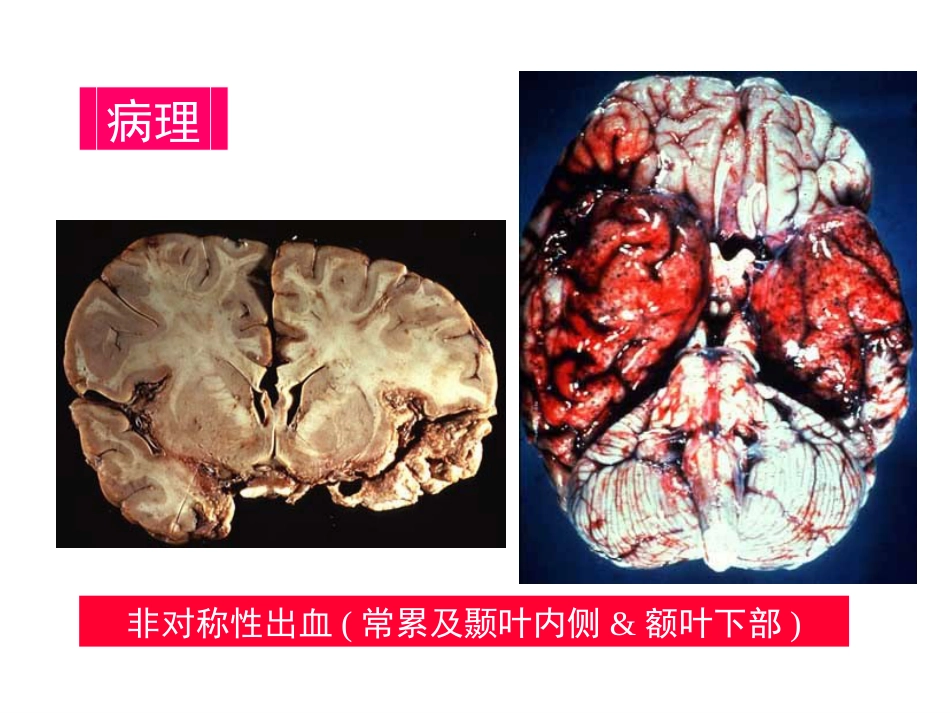中枢神经系统感染 (3)_第13页