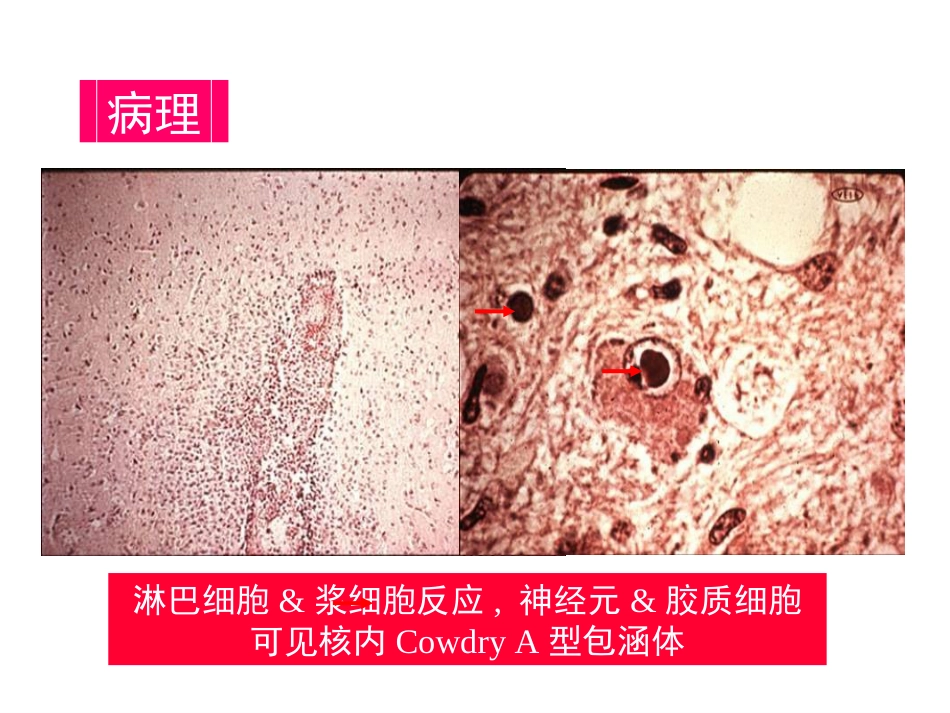 中枢神经系统感染 (3)_第14页