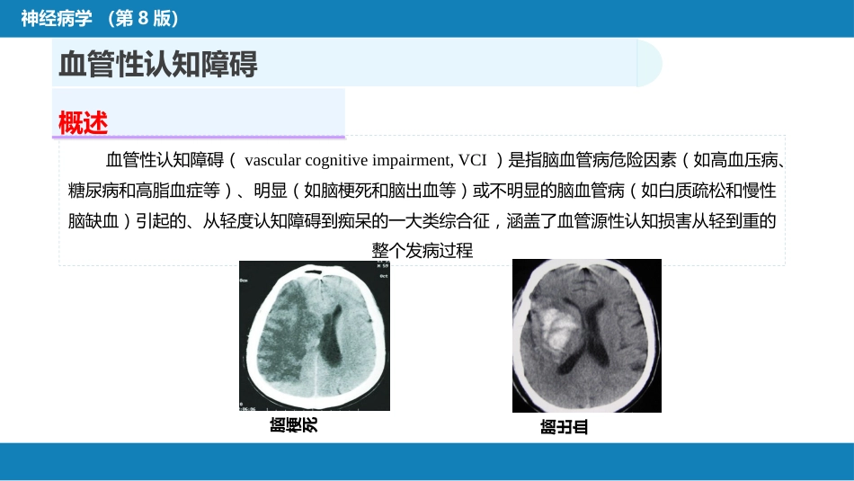 第九章 脑血管疾病（5）_第3页
