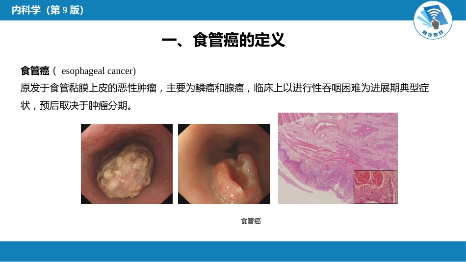 消化内科：食管癌_第3页