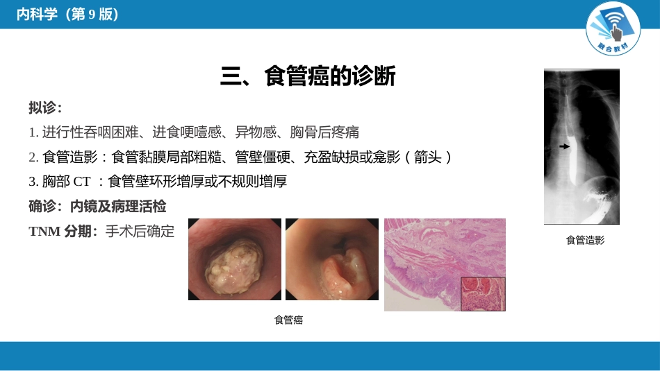 消化内科：食管癌_第6页