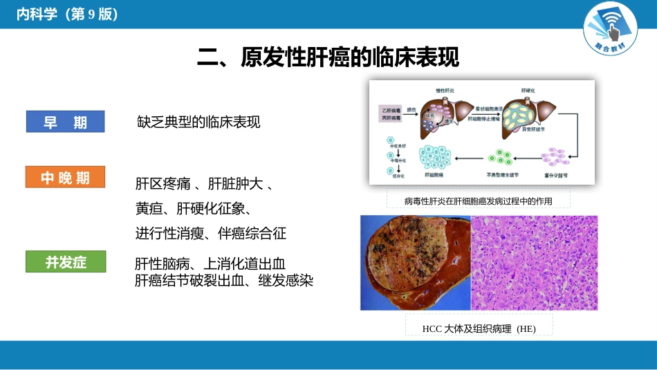 消化内科：原发性肝癌_第4页