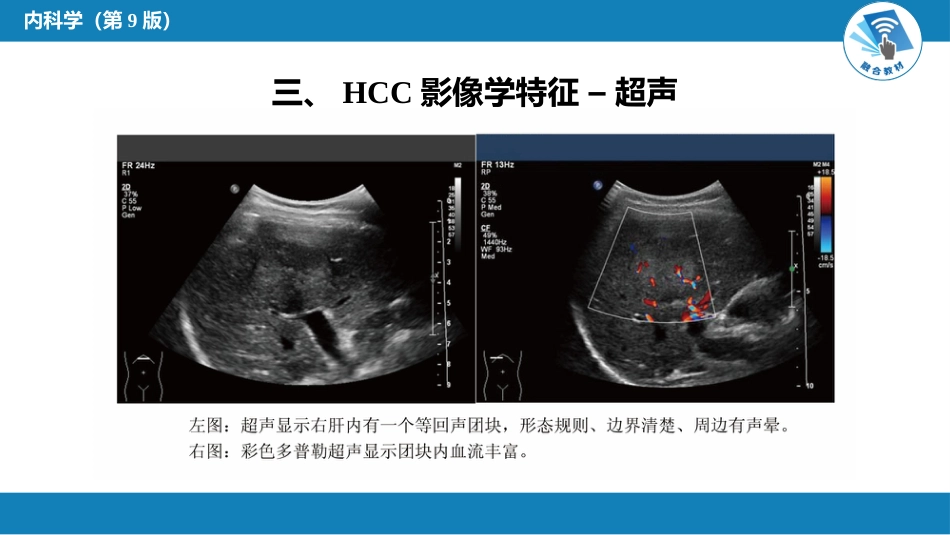 消化内科：原发性肝癌_第5页
