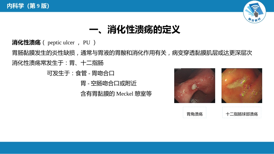 消化内科：消化性溃疡_第3页