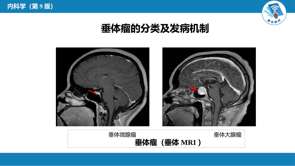 内分泌科：垂体瘤_第6页