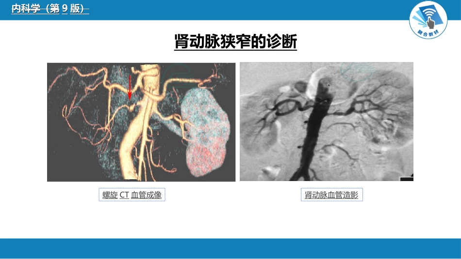 肾内科：肾血管疾病_第9页
