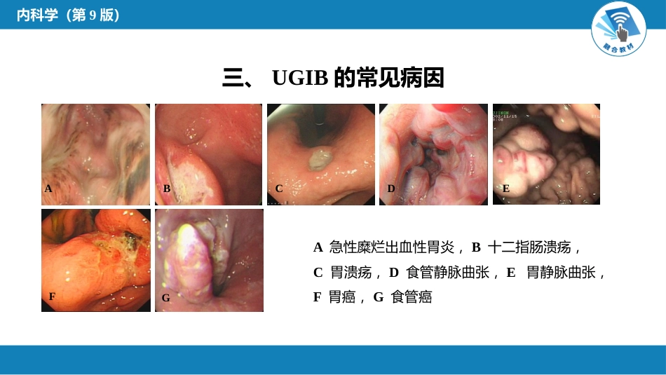 消化内科：消化道出血_第5页