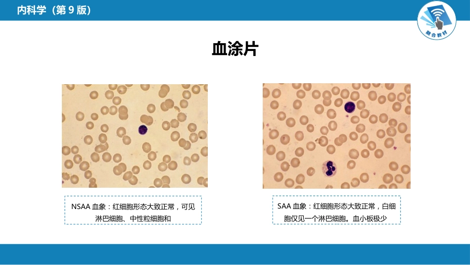 血液科：再生障碍性贫血_第10页