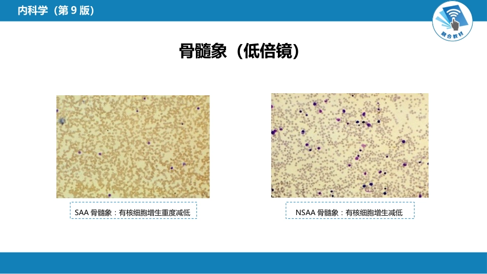 血液科：再生障碍性贫血_第12页