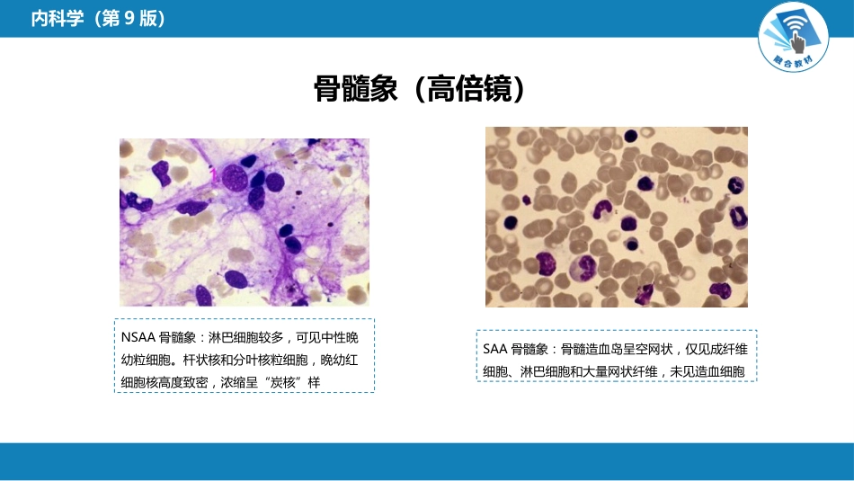 血液科：再生障碍性贫血_第13页