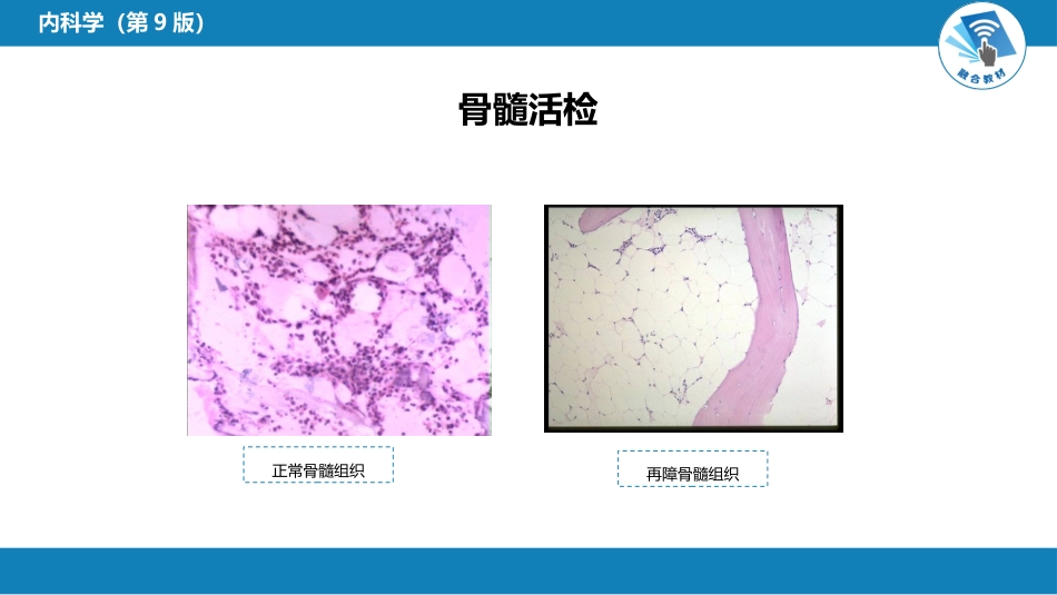 血液科：再生障碍性贫血_第14页