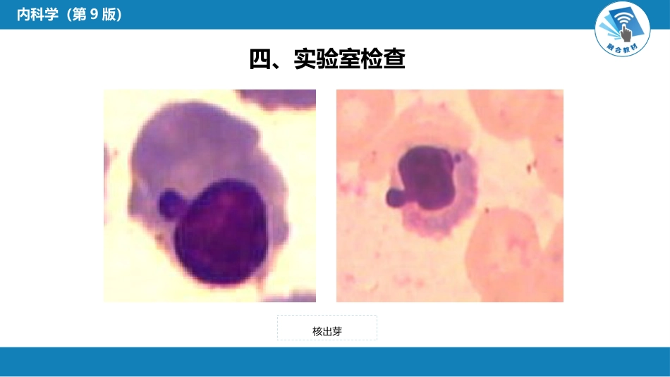 血液科：骨髓增生异常综合征_第13页