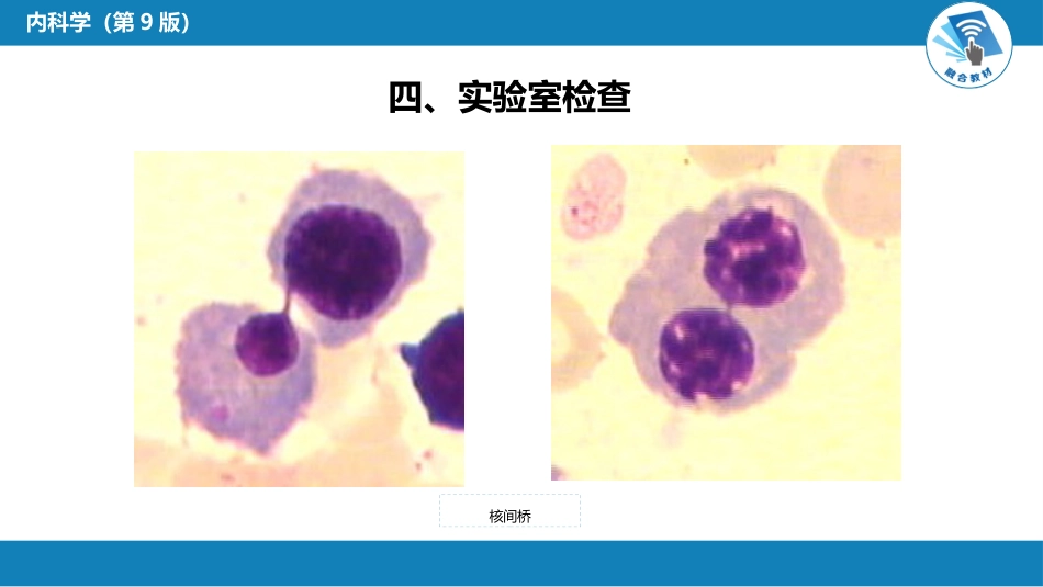 血液科：骨髓增生异常综合征_第14页