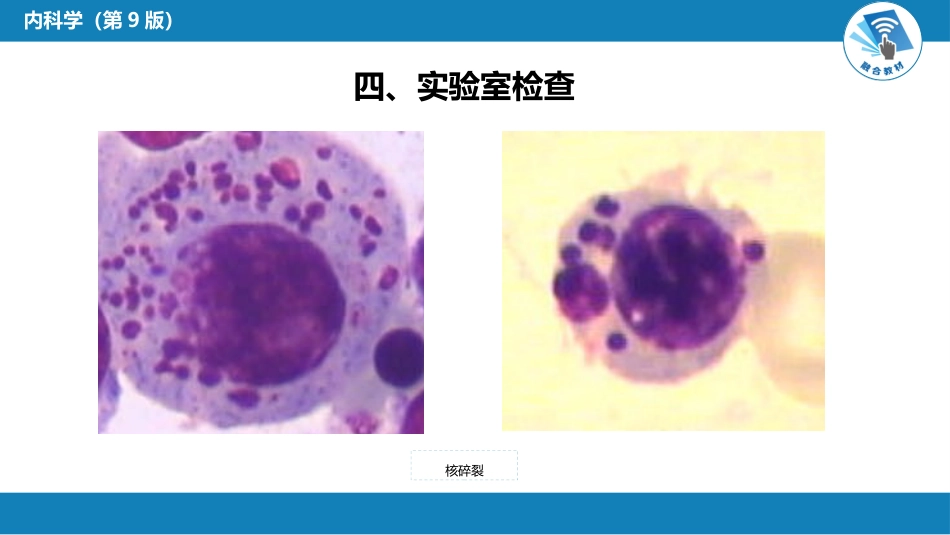 血液科：骨髓增生异常综合征_第15页