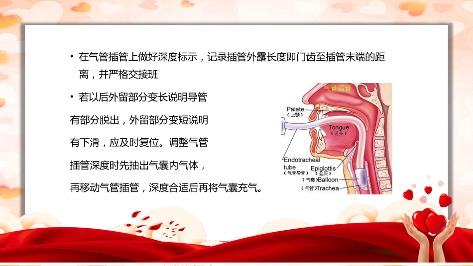 气管插管病人及呼吸机的护理_第10页