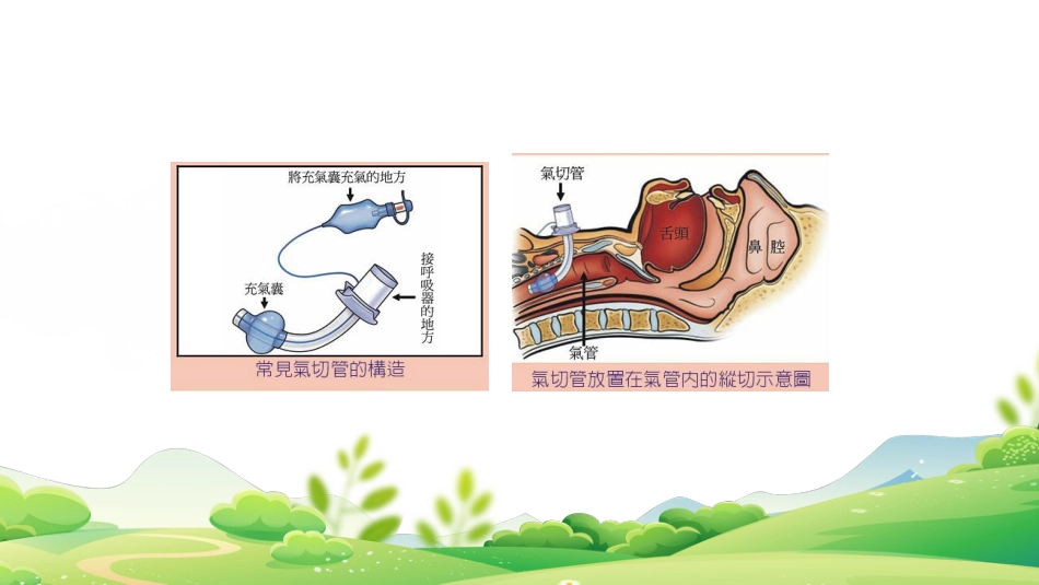 气管插管、气管切开吸痰术_第3页