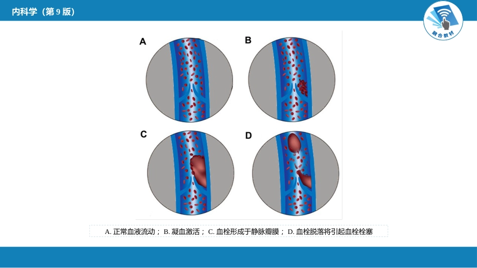 血液科：血栓性疾病_第4页