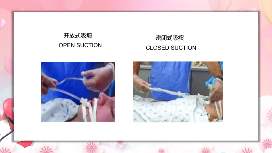 气管插管的护理_第13页