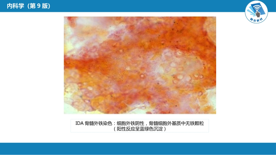 血液科：缺铁性贫血_第9页