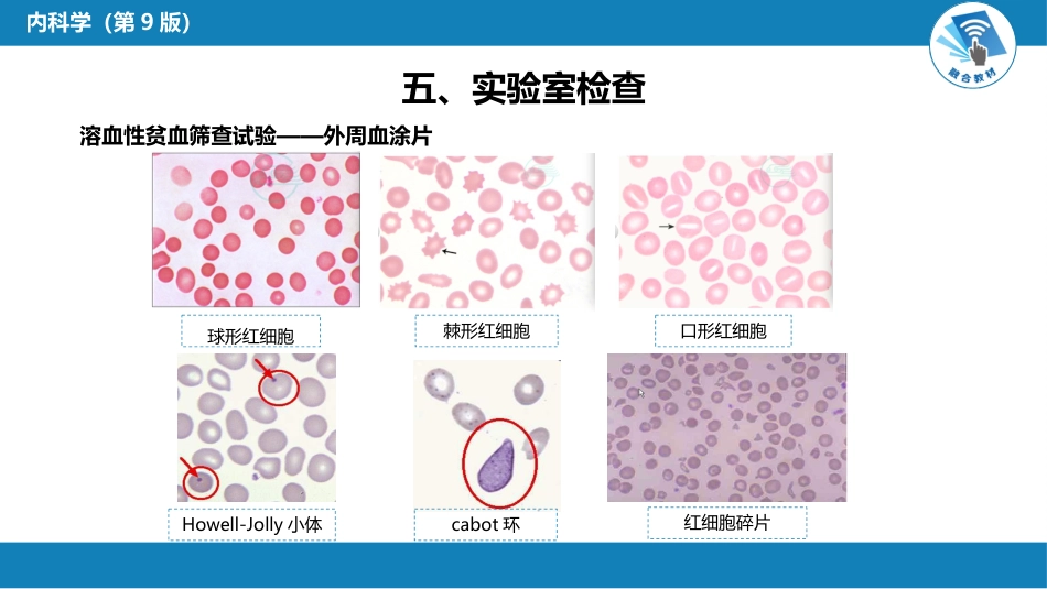血液科：溶血性贫血（第1-4节）_第14页