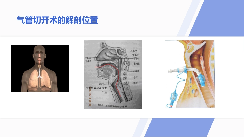 气管切开病人的伤口护理_第4页