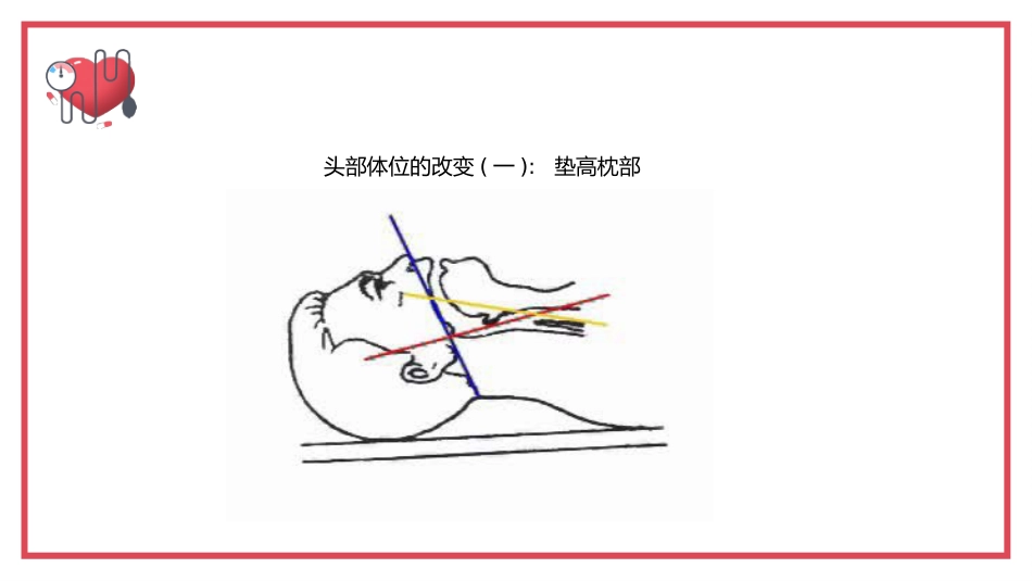 气管内插管术2_第10页