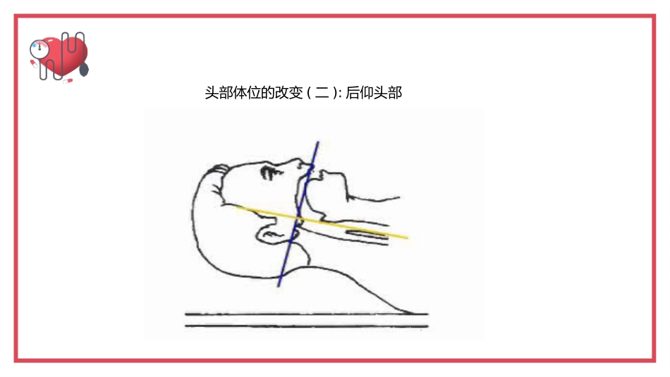 气管内插管术2_第11页