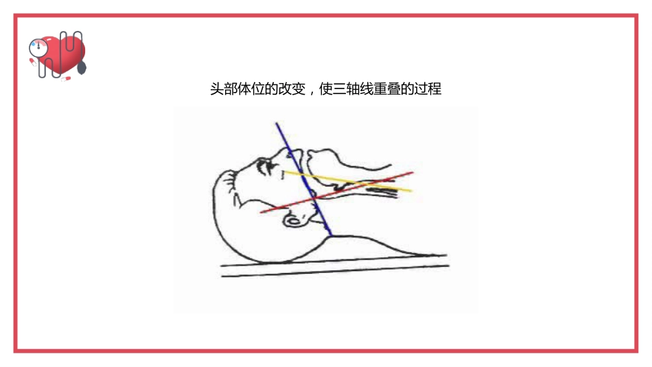 气管内插管术2_第12页