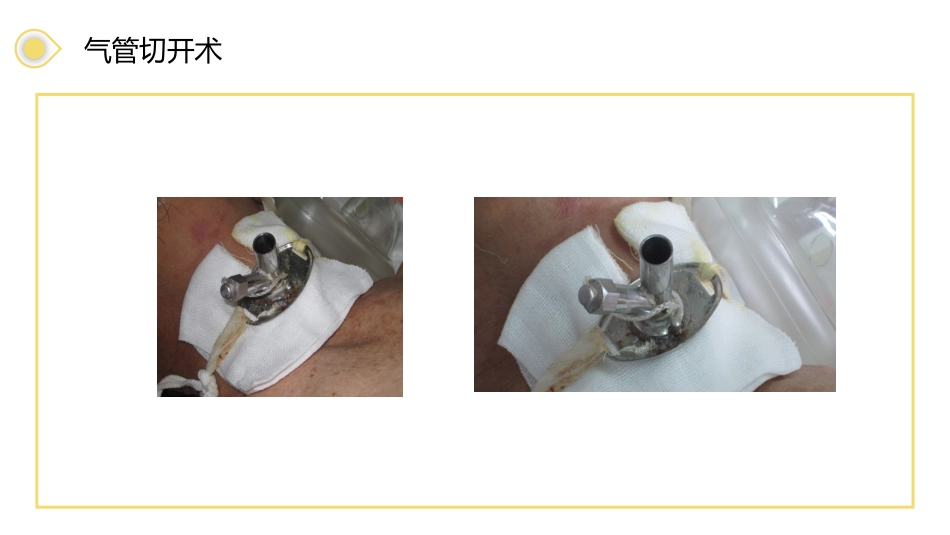 气管切开病人的护理3_第11页